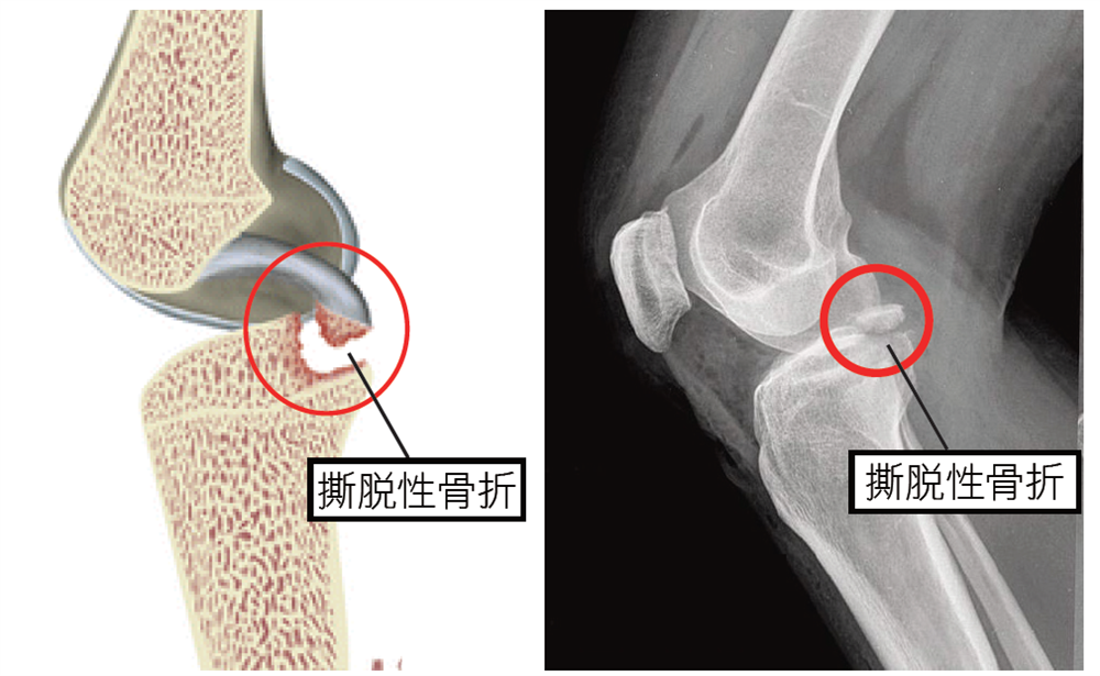 PCL Avulsion Fracture